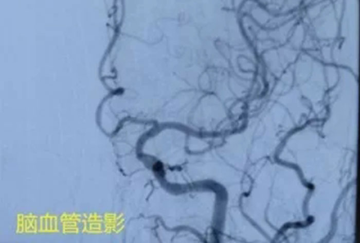 当“脑梗死”遇到“心绞痛”，我们这么做——我院神经内科和心内科连台协作为一患者完成心脑血管造影手术