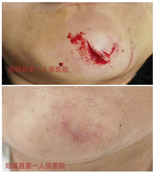 美容缝合术——让损伤皮肤重新焕发光彩