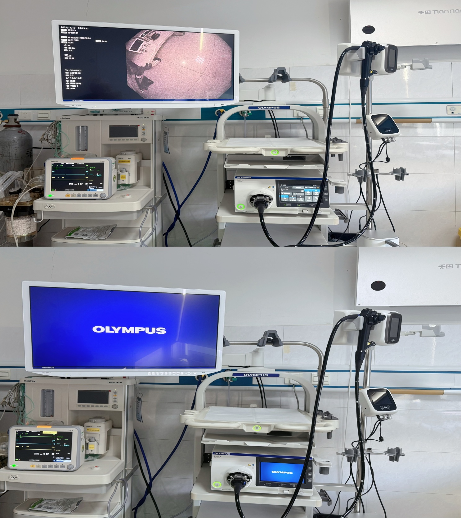 新设备，硬实力——我院内镜中心引进奥林巴斯X1高清胃肠镜系统