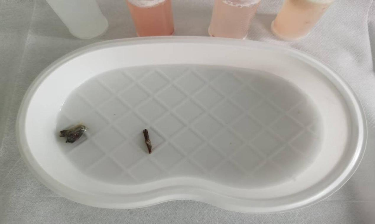 多学科协作成功完成一例支气管异物取出术