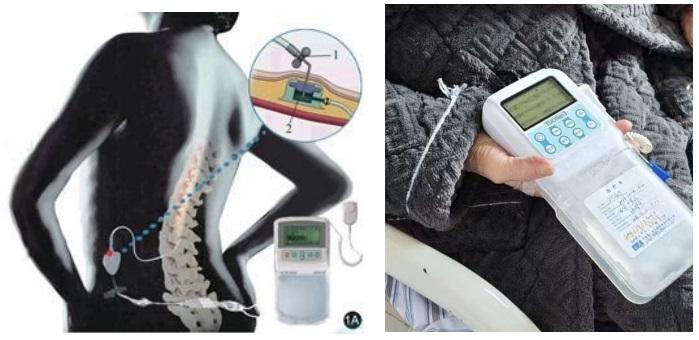 鞘内药物输注：为癌痛患者点亮“无痛”希望